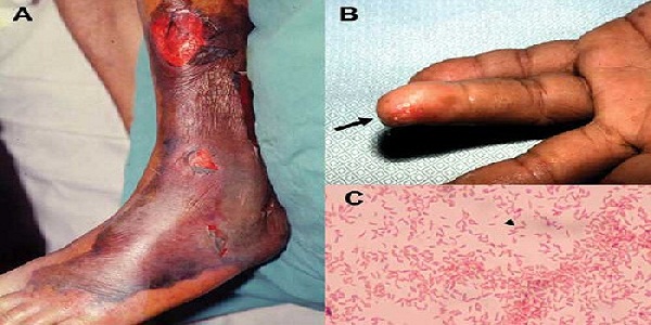 Oh Crap. Vibrio Vulnificus Another Possible Flesh Eating Bacteria