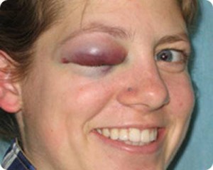 beaten wife